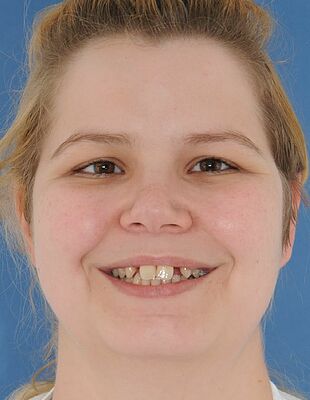 Unsichtbare Zahnspange - Vor der Behandlung mit Alignern, Patient