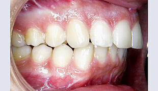 Unsichtbare Zahnspange - Nach der Behandlung mit Alignern, Kiefer