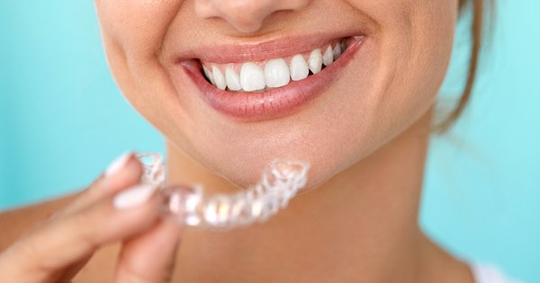 Warum immer mehr Erwachsene sich für Zahnspangen entscheiden
