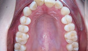 Unsichtbare Zahnspange - Vor der Behandlung mit Invisalign, Kiefer