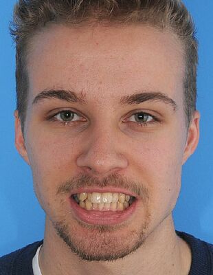 Unsichtbare Zahnspange - Vor der Behandlung mit Invisalign, Patient