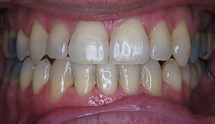 Unsichtbare Zahnspange - Nach der Behandlung mit Invisalign, Kiefer