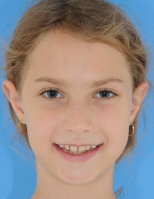 Unsichtbare Zahnspange - Nach der Behandlung mit Invisalign, Patient
