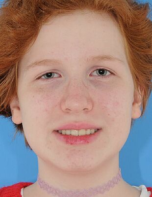 Unsichtbare Zahnspange - Nach der Behandlung mit Invisalign, Patient