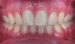 Unsichtbare Zahnspange - Nach der Behandlung mit Invisalign, Kiefer