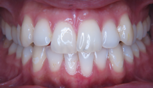 Unsichtbare Zahnspange - Vor der Behandlung mit Invisalign, Kiefer
